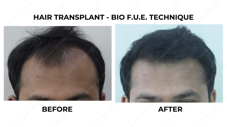 Best Hair Transplant Thane Dr Narendra Nikumbh 10