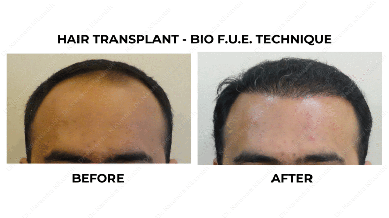 Best Hair Transplant Thane Dr Narendra Nikumbh 11