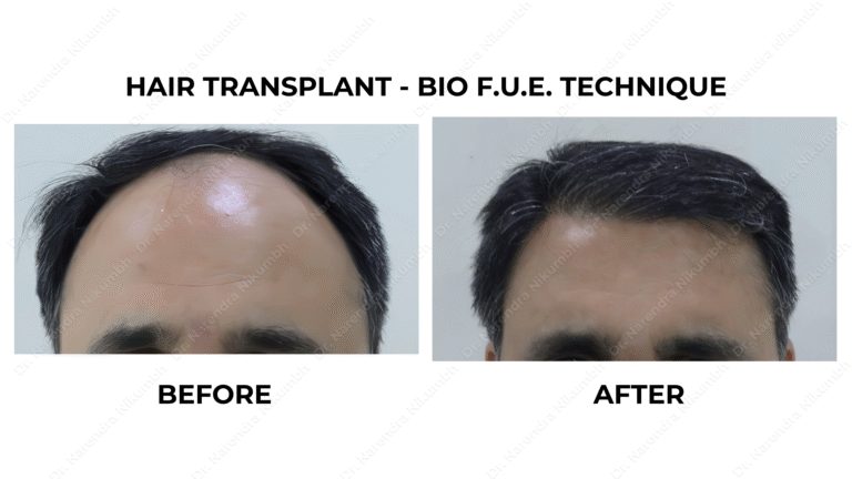 Best Hair Transplant Thane Dr Narendra Nikumbh 12