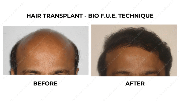 Best Hair Transplant Thane Dr Narendra Nikumbh 13
