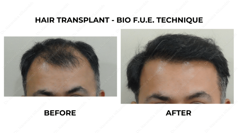 Best Hair Transplant Thane Dr Narendra Nikumbh 14