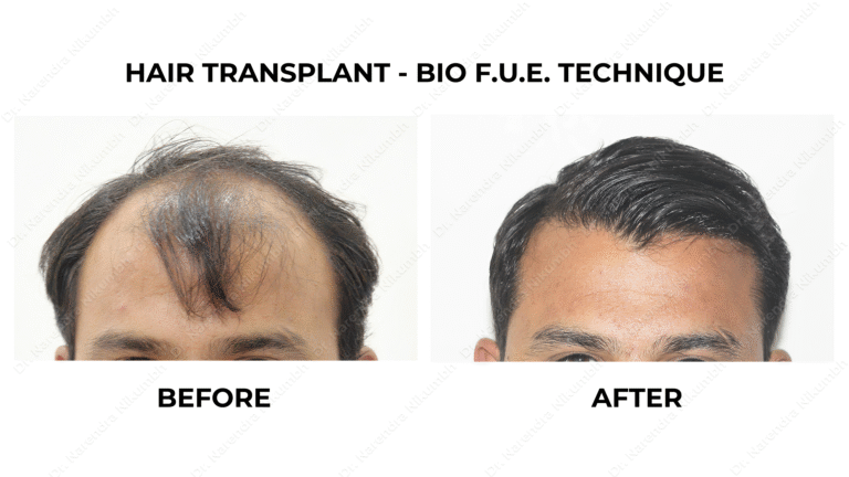 Best Hair Transplant Thane Dr Narendra Nikumbh 15