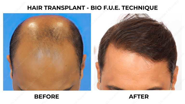 Best Hair Transplant Thane Dr Narendra Nikumbh 16