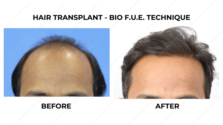Best Hair Transplant Thane Dr Narendra Nikumbh 18