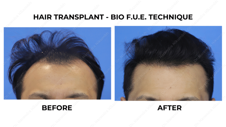 Best Hair Transplant Thane Dr Narendra Nikumbh 19