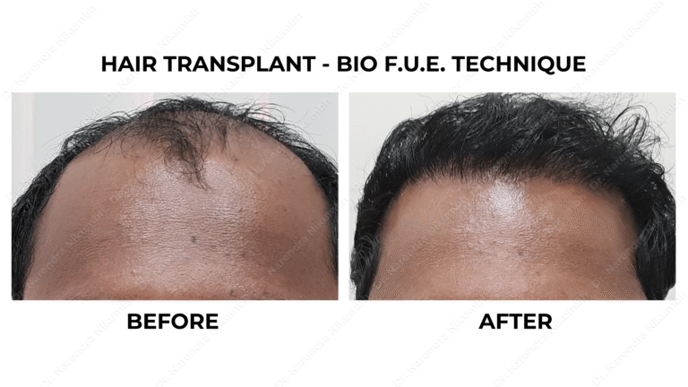 Best Hair Transplant Thane Dr Narendra Nikumbh 2