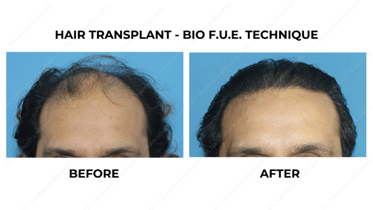 Best Hair Transplant Thane Dr Narendra Nikumbh 20