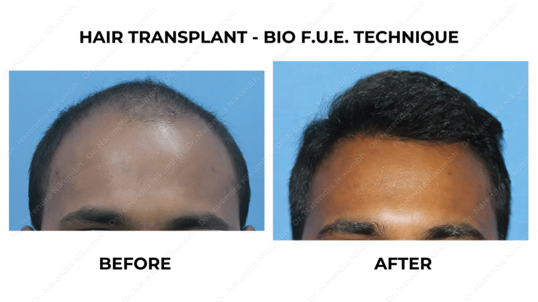 Best Hair Transplant Thane Dr Narendra Nikumbh 21