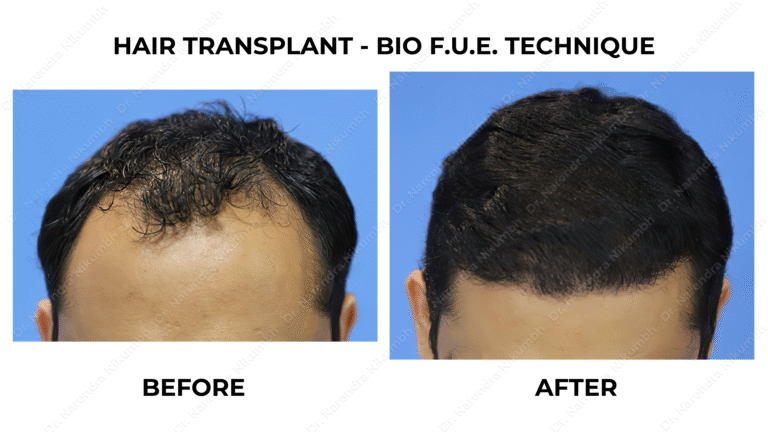 Best Hair Transplant Thane Dr Narendra Nikumbh 22