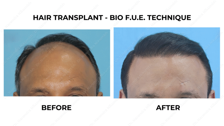 Best Hair Transplant Thane Dr Narendra Nikumbh 23