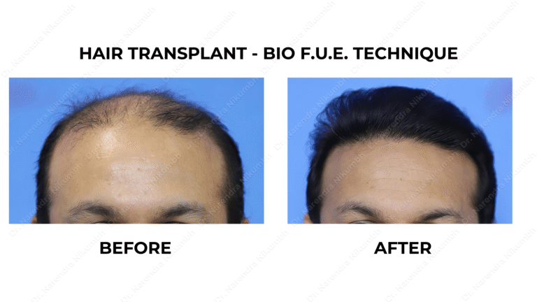 Best Hair Transplant Thane Dr Narendra Nikumbh 24