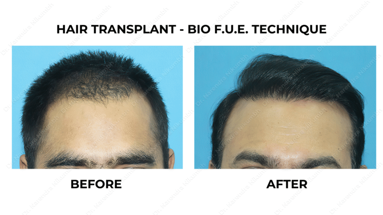 Best Hair Transplant Thane Dr Narendra Nikumbh 26