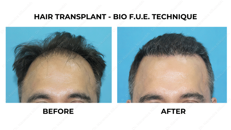 Best Hair Transplant Thane Dr Narendra Nikumbh 27