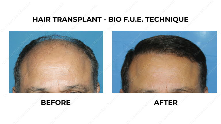 Best Hair Transplant Thane Dr Narendra Nikumbh 29