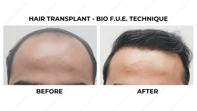 Best Hair Transplant Thane Dr Narendra Nikumbh 3