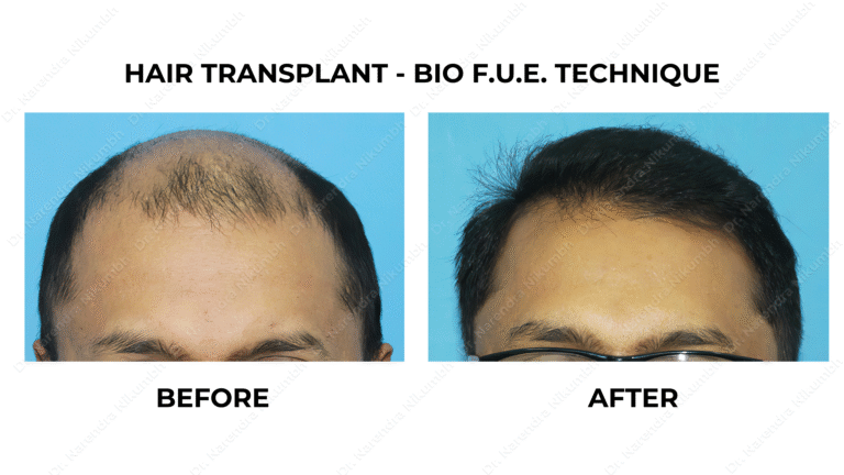 Best Hair Transplant Thane Dr Narendra Nikumbh 30 - Copy