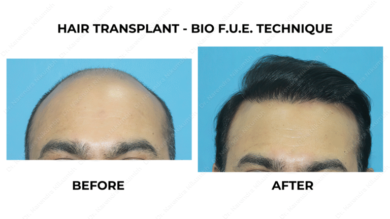 Best Hair Transplant Thane Dr Narendra Nikumbh 31