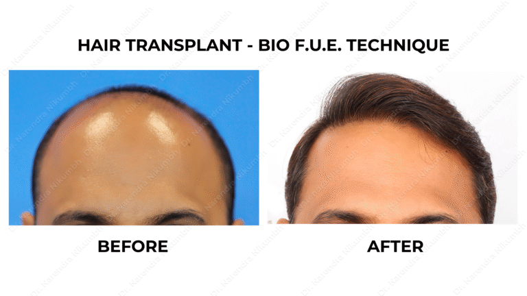 Best Hair Transplant Thane Dr Narendra Nikumbh 32