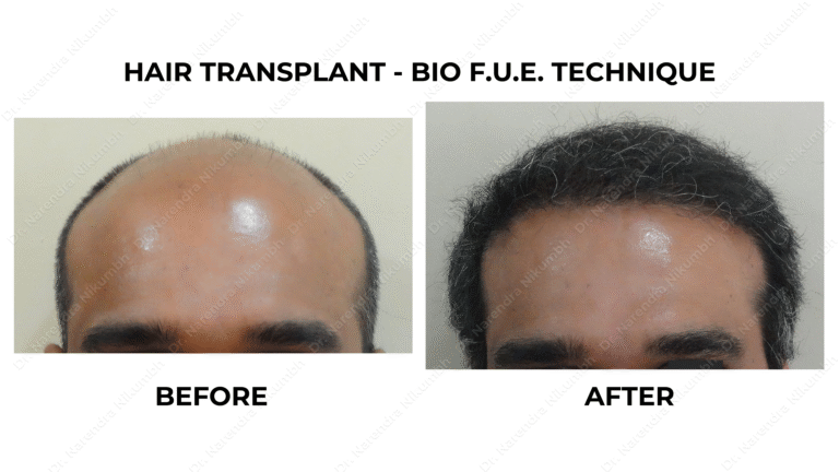 Best Hair Transplant Thane Dr Narendra Nikumbh 8